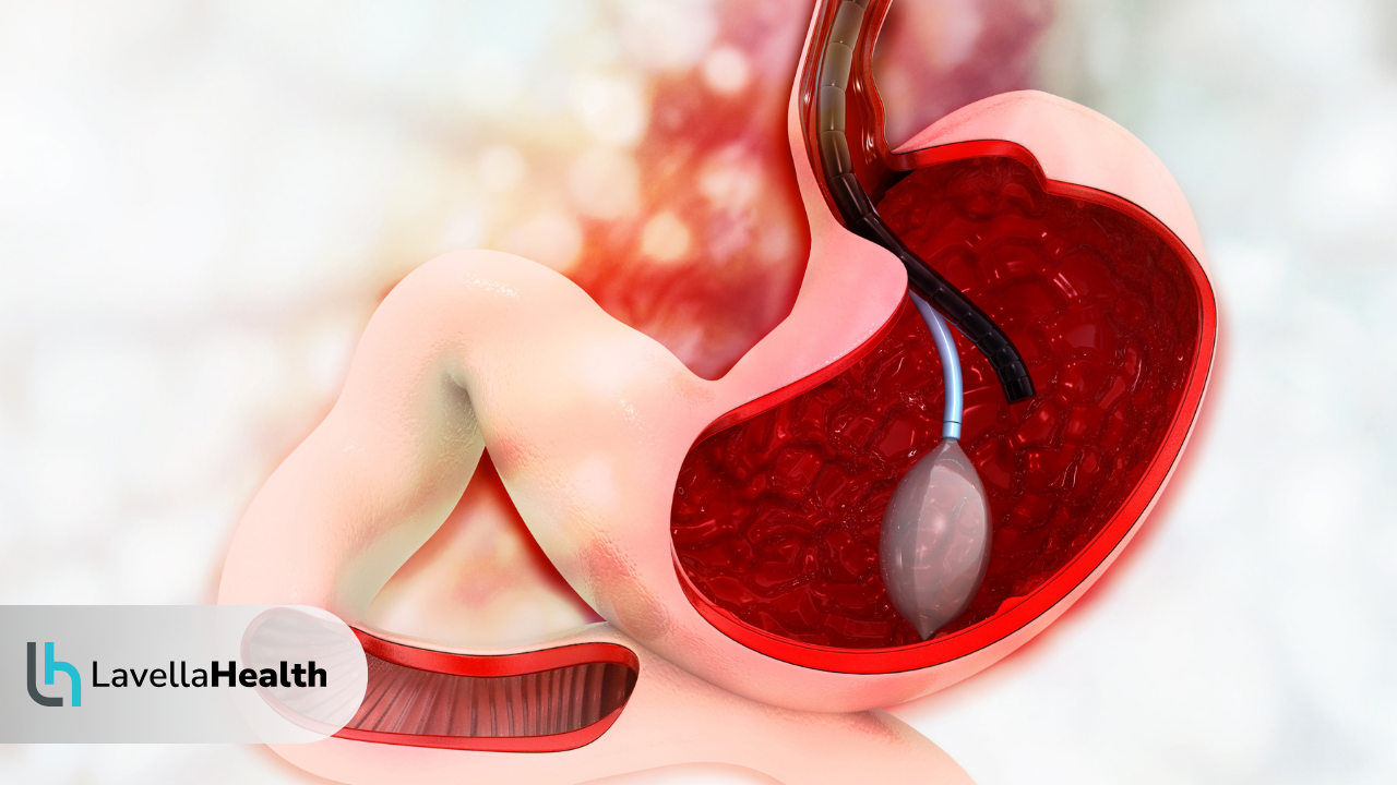 стомашен балон