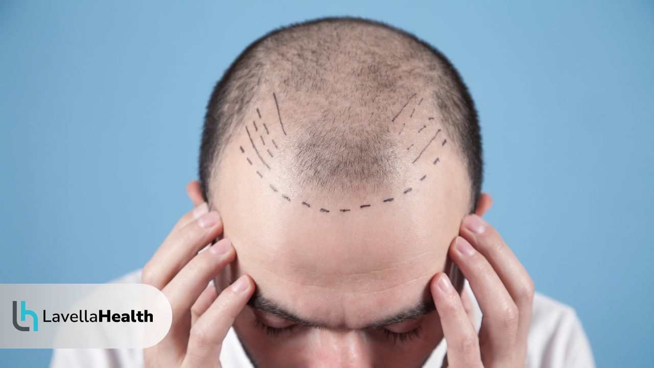 DHI трансплантация на коса