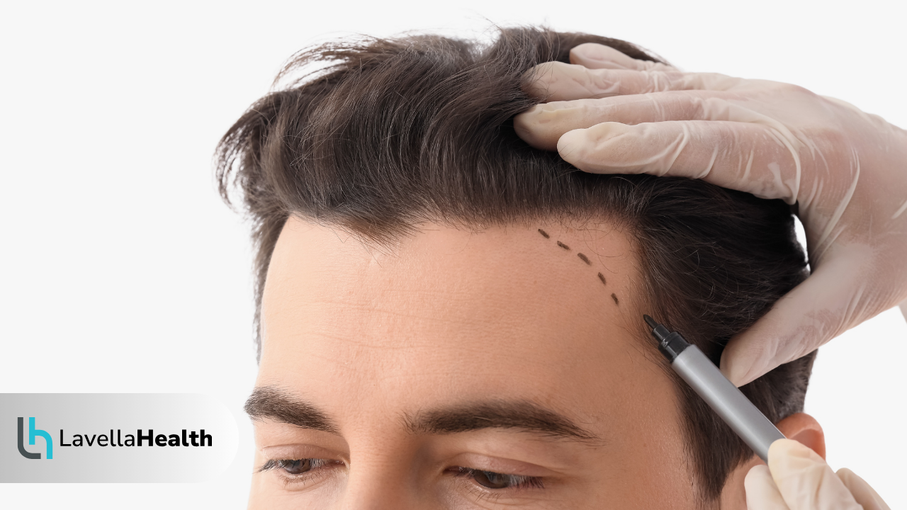 Брада и Мустаци Трансплантация Решение за Редки Зони при Мъжете