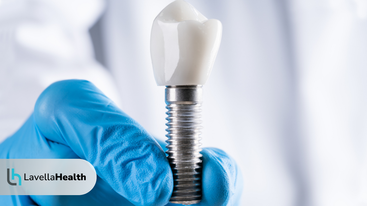 Колко време трае лечението с дентални импланти